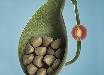 Safra Kesesi Taşı ve Çamurlaşmasında Beslenme
